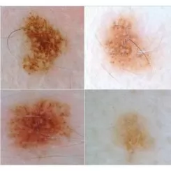 Фото Аппарат (эл-й микроскоп) для исследования кожи и волос RL-2002 + TV + 2 линзы 50х и 200х - 5